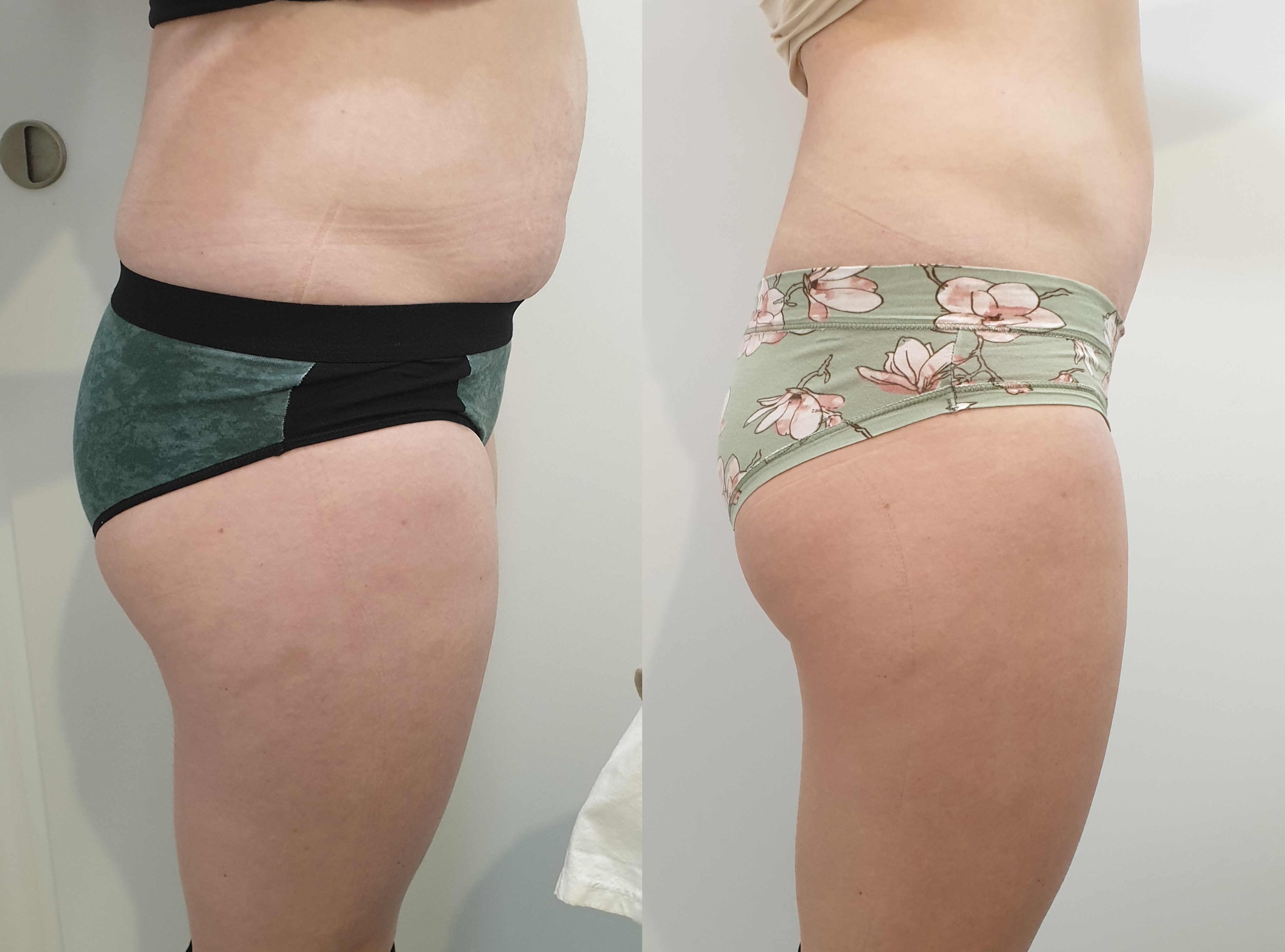 before and after results of fat loss tratments at Mali Salon